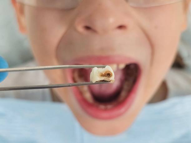 Best Emergency Treatment for Oral Infections in Groveton, VA