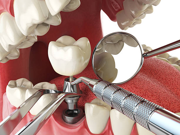 Best Lost Filling or Crown Replacement in Groveton, VA